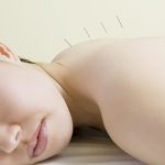 vrouw ondergaat TENS na acupunctuur
